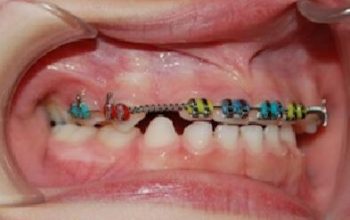 Ortodòncia amb brackets